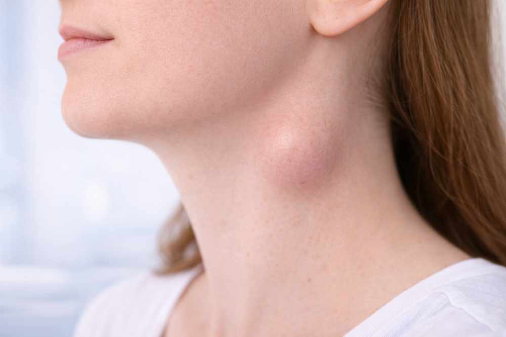 вродена киста на шията в областта на челюстта при пациент